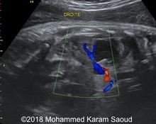 Duplex kidney image