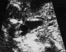 Anterior sacral meningocele image