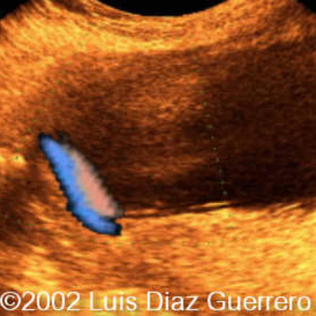 📃 Cord, velamentous insertion