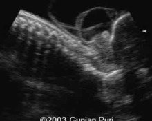 Occipital meningoencephalocele and amniotic band syndrome image