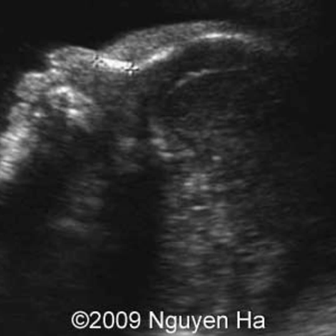 📃 Roberts syndrome