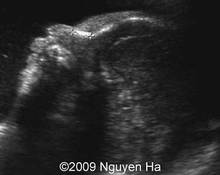 Roberts syndrome image