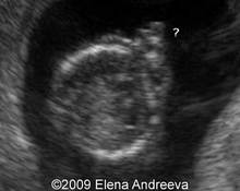 Cleft lip and palate, 12 weeks image