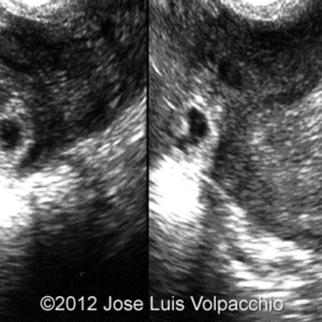 📃 Interstitial Ectopic Pregnancy