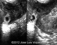 Interstitial ectopic pregnancy image