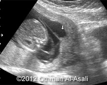 Incomplete rupture of amniotic membrane image