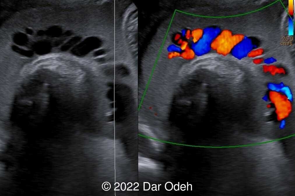 📃 Highly echogenic amniotic fluid