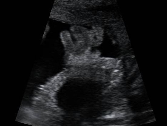 Image of a posterior placenta showing a hypoechoic hematoma between the placenta and the uterine wall.