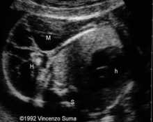 Cystic hygroma, axillary, cervico-mediastinal image