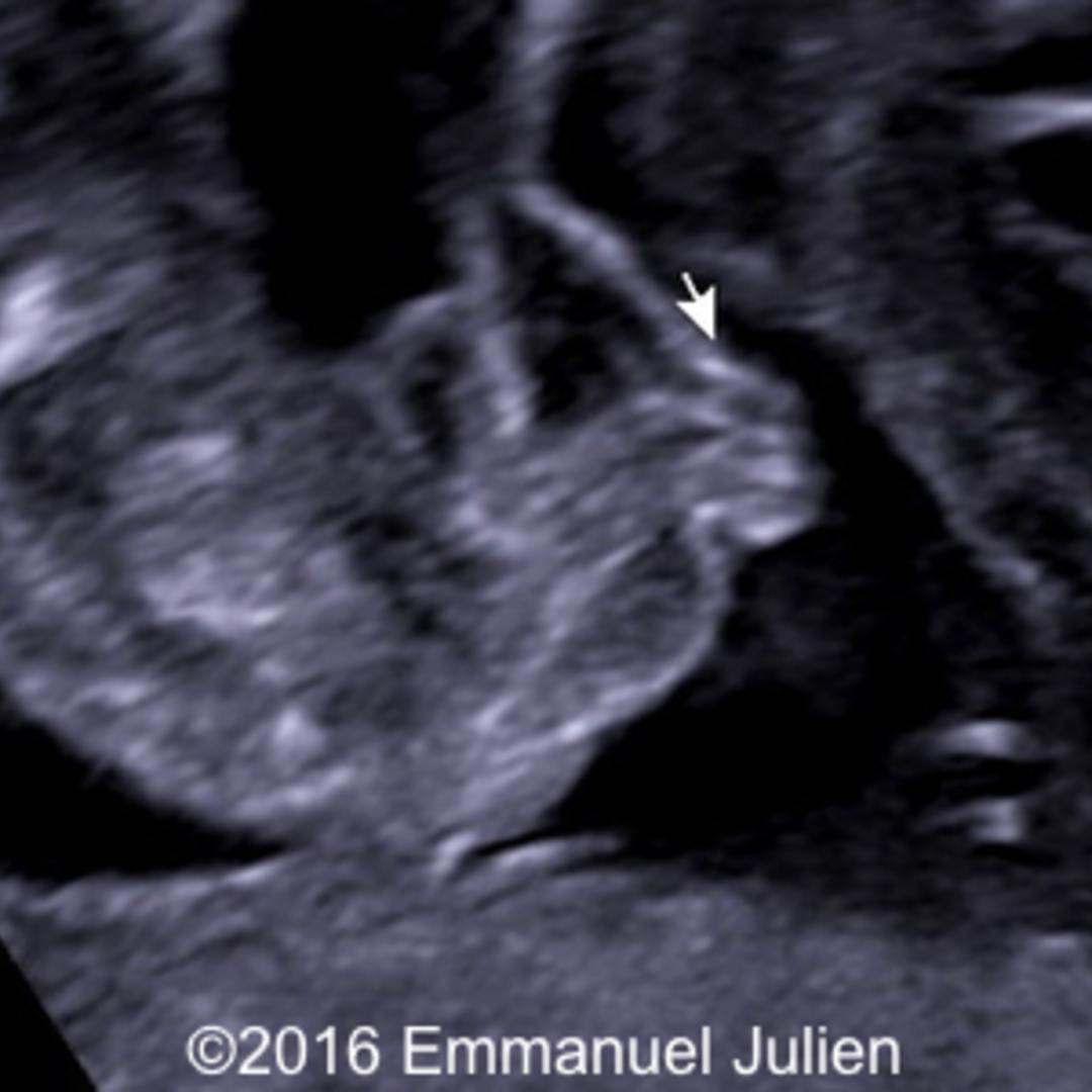 Ambiguous Genitalia Ultrasound 
