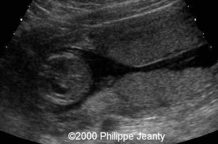 📃 Succenturiate & bilobate placenta