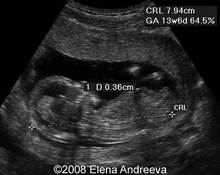Congenital lymphedema image