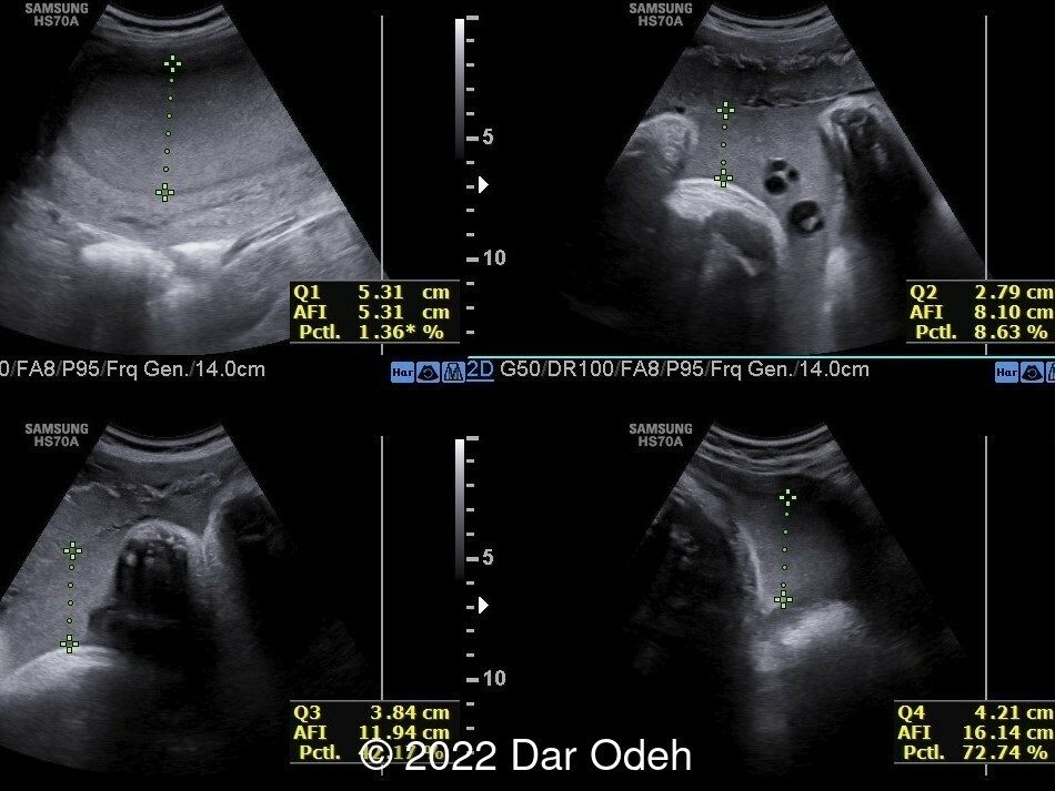 Normal AFI measurement.