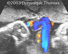 Umbilical vein fenestration image