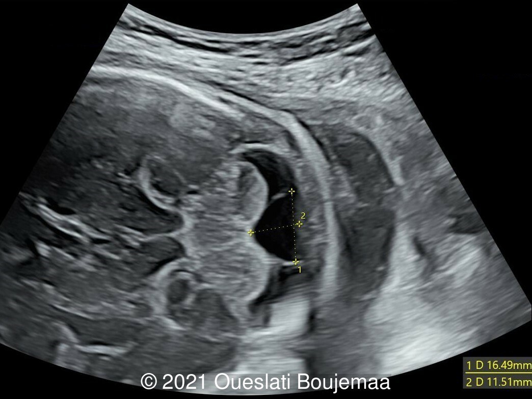 Us obstetric nuchal dating scan in Maracaibo