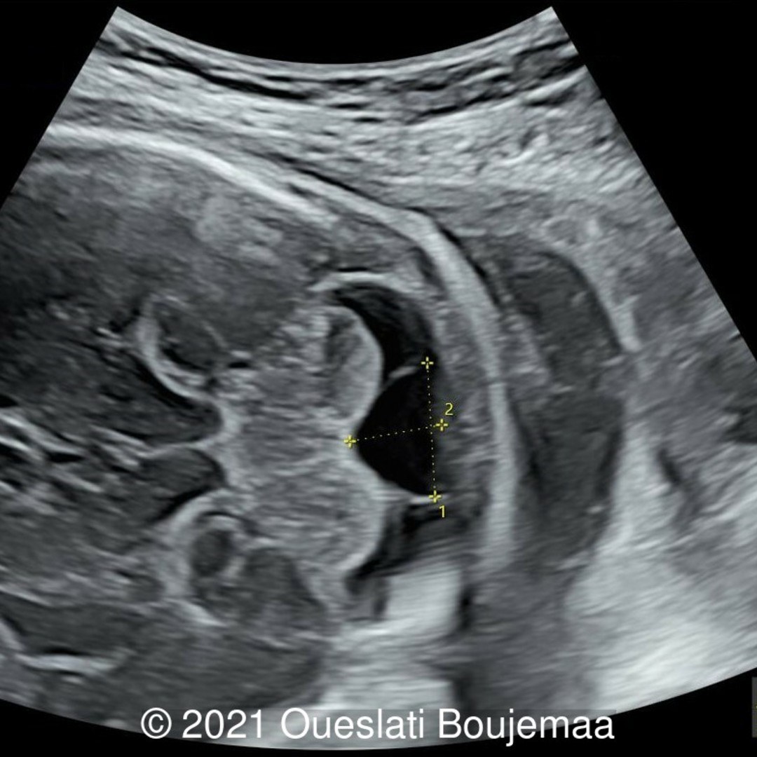 Prenatal Diagnosis of Spontaneous Septostomy in Dichorionic Diamniotic  Twins and Review of the Literature - Jeanty - 2010 - Journal of Ultrasound  in Medicine - Wiley Online Library