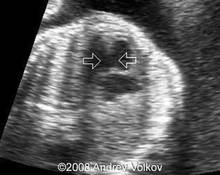 Amniotic rupture image