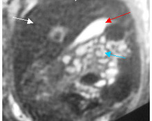 Magnetic Resonance in the fetus, Part 2 image