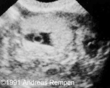 Tubal triplet pregnancy image