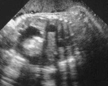 Fetus-in-fetu image