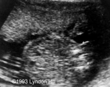 Fetus in fetu image