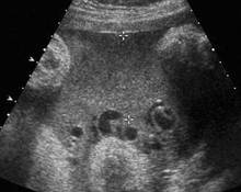 Echogenic amniotic fluid image