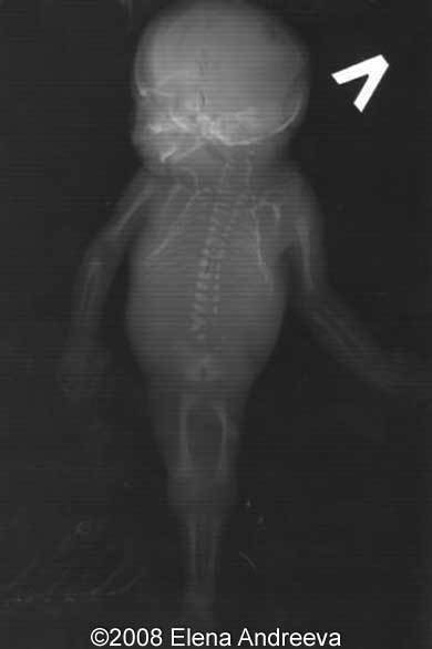 sirenomelia x ray