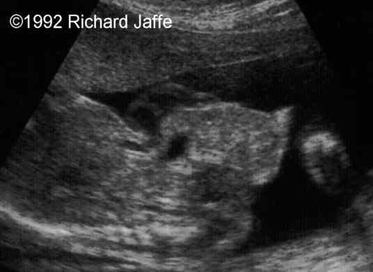 bladder exstrophy ultrasound