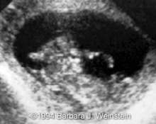 Meckel syndrome, first trimester diagnosis image