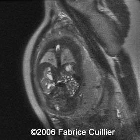 neuroblastoma in unborn babies