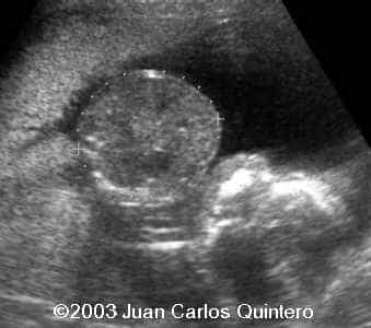 abd. circunference 18 weeks