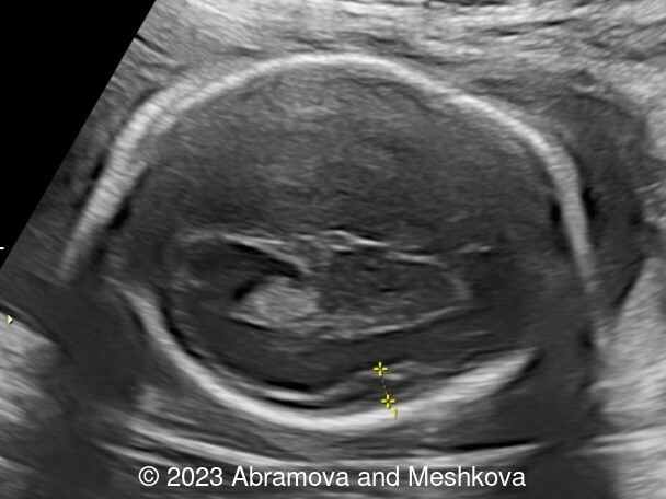 Transverse section of the brain at 23-24 weeks of gestation. Distance 0.50 cm