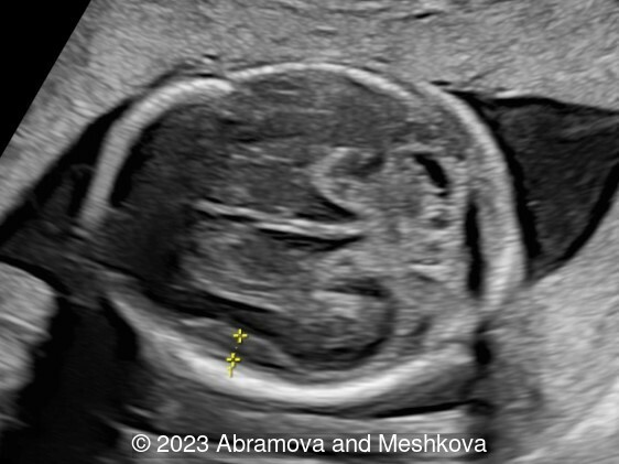 Transverse section of the brain at 21-22 weeks of gestation. Distance 0.39 cm