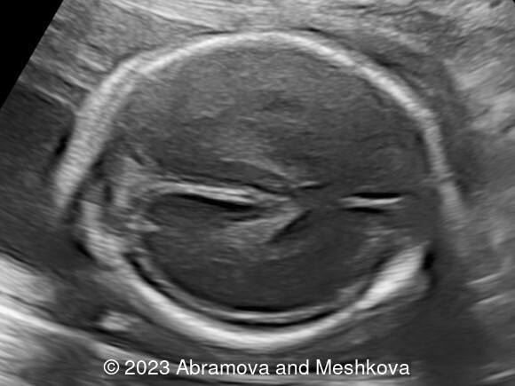 Transverse section of the brain at 23-24 weeks of gestation. 