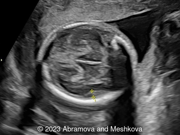 Transverse section of the brain at 20-21 weeks of gestation. Distance 0.40cm