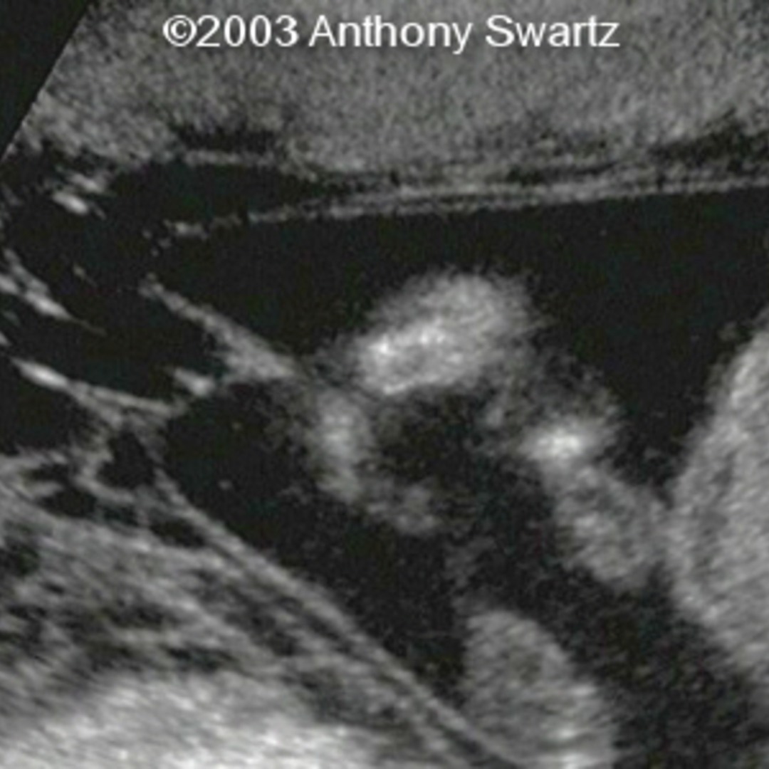 📃 Amniotic band syndrome
