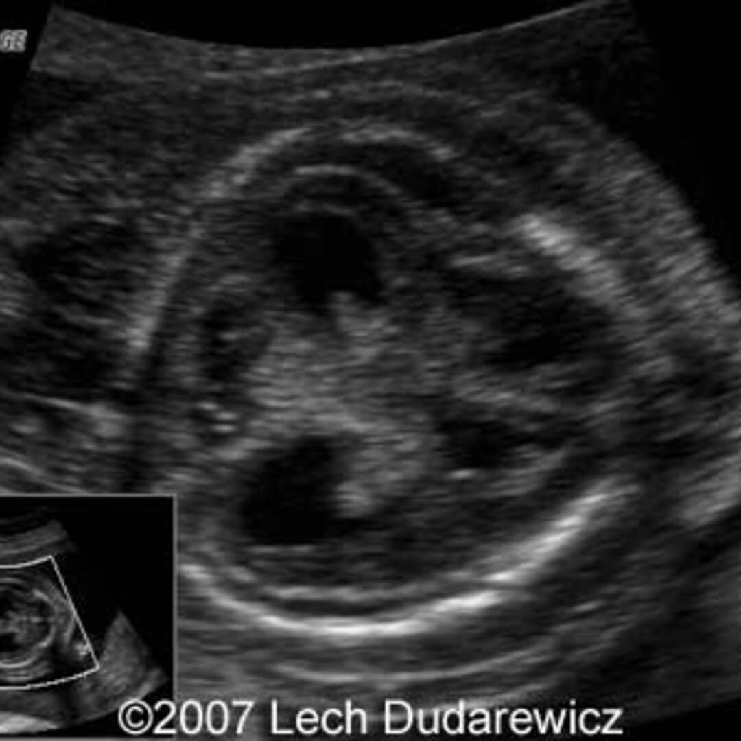 📃 TRAP syndrome case report and perspectives of prenatal therapy