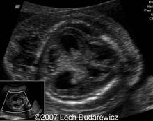 TRAP syndrome: case report and perspectives of prenatal therapy image
