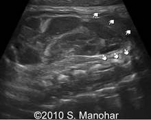 Congenital adrenal hyperplasia image