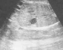 Esophageal atresia with tracheo-esophageal fistula image