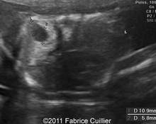 Congenital lobar adenomatosis and amniotic band syndrome image