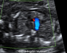 Supravalvular aortic stenosis image
