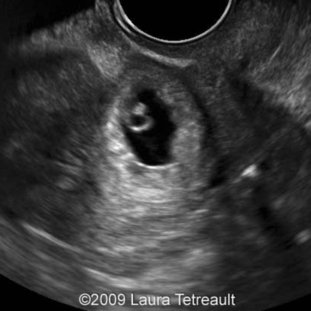 📃 Cesarean-section scar, ectopic pregnancy