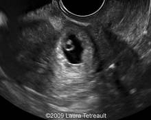 Cesarean-section scar, ectopic pregnancy image