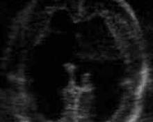 Thanatophoric dysplasia image