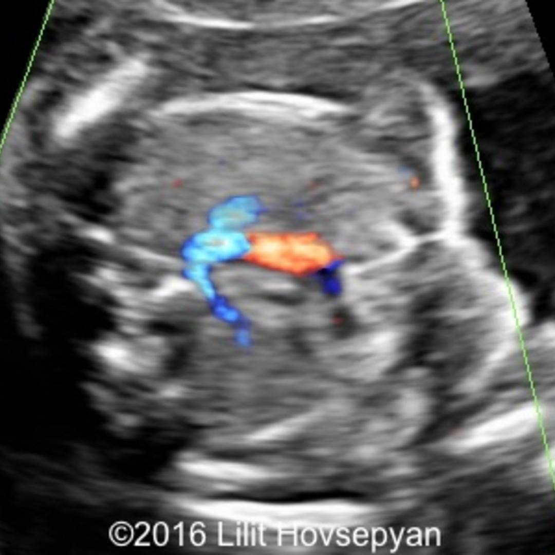 📃 Aberrant right subclavian artery (ARSA)