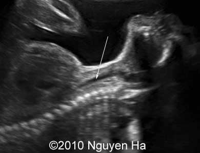 Case_277_1a