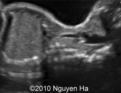 Case_277_3