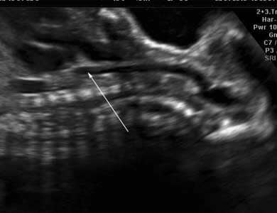 Case_277_4a