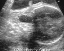 Vallecular cyst image